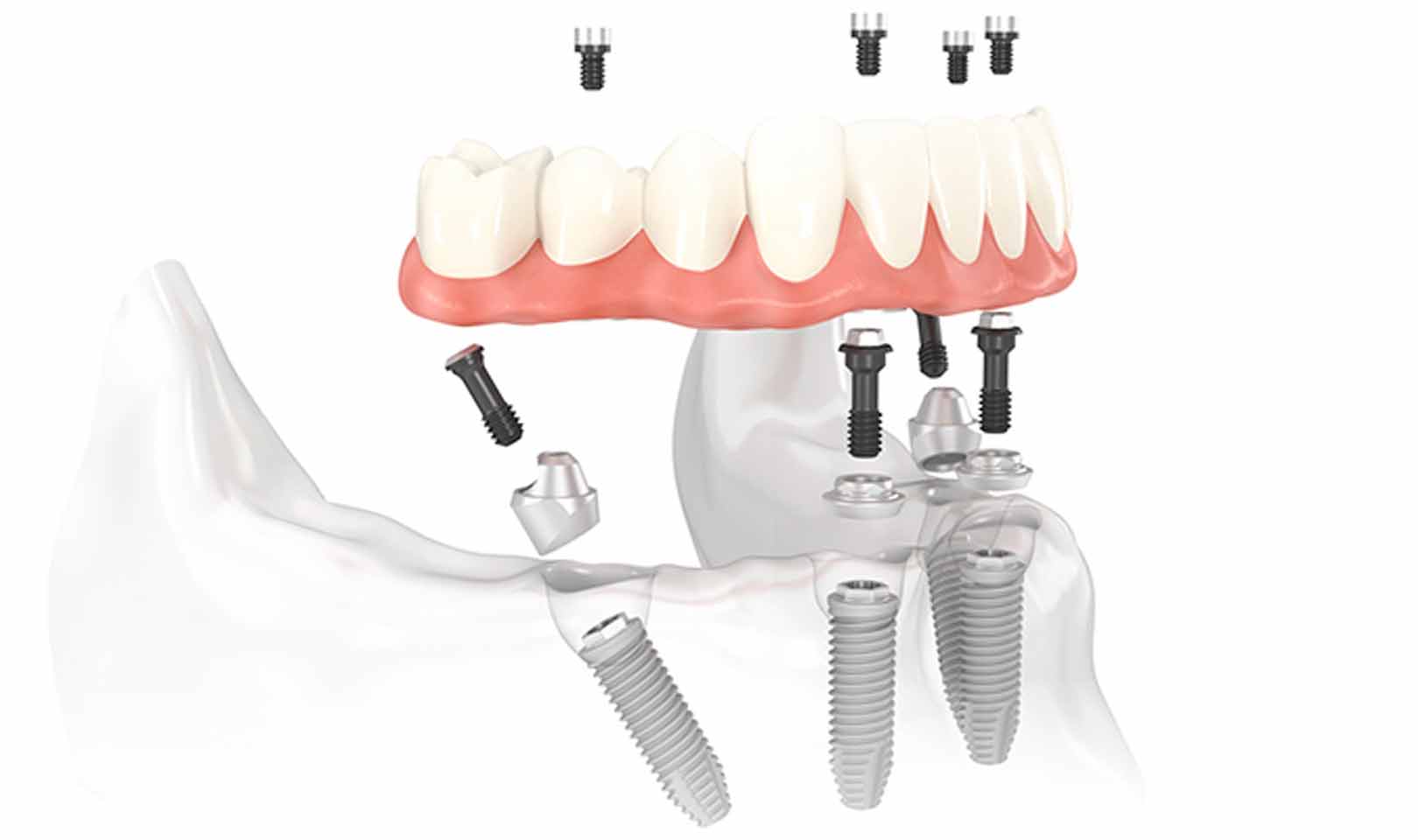 All on four impianti dentali singolo-Brindisi