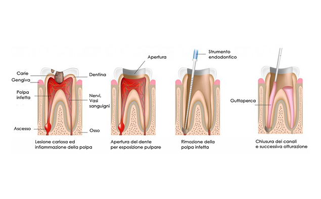 Trattamento endodontico studio dentistico devitalizzazione Brindisi
