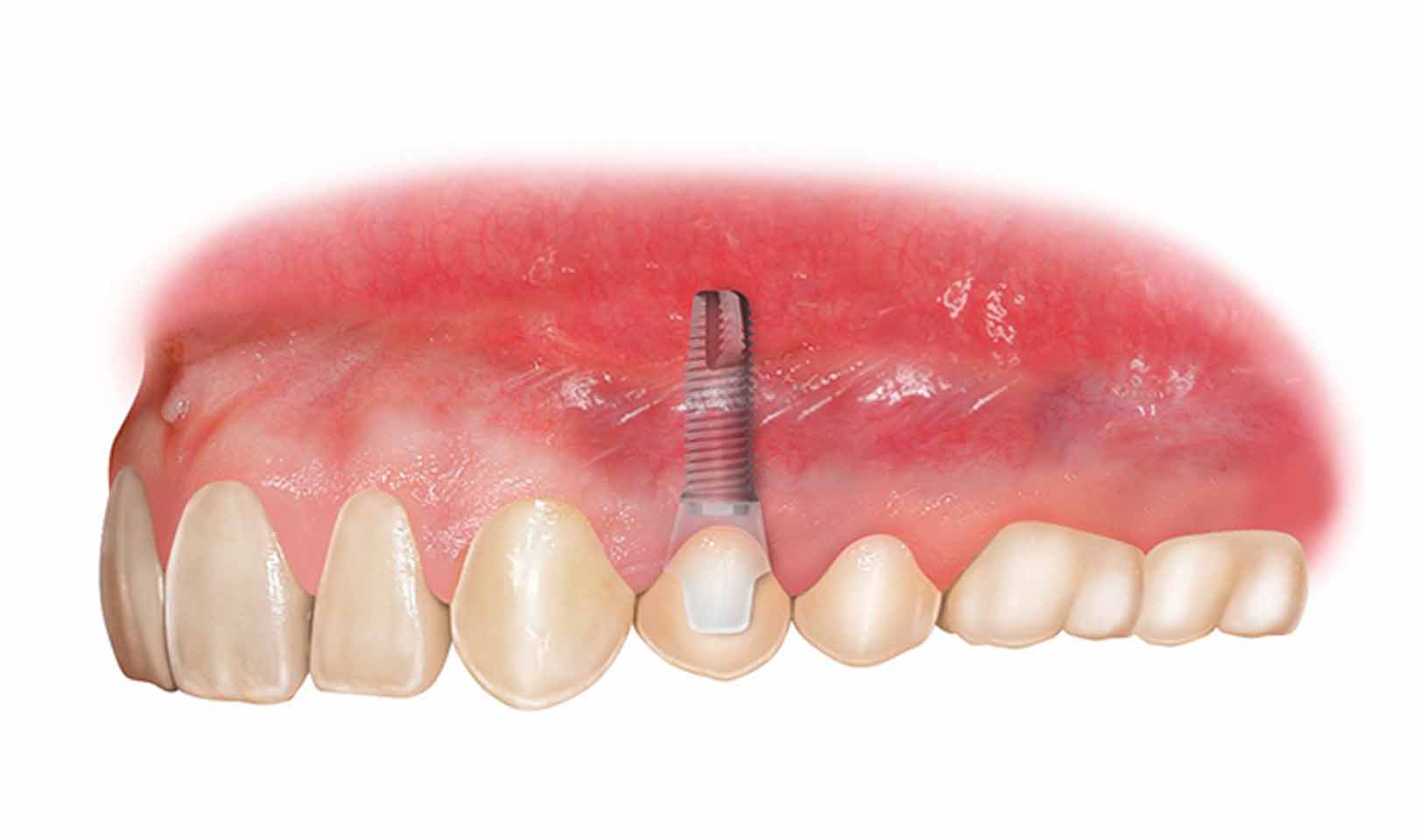Mini impianto dentale