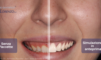 Faccette dentali: valutare il risultato estetico in anticipo con la progettazione digitale