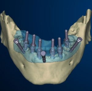 implantologia computer guidata Bindisi Dentista Centro Dentistico San Lorenzo